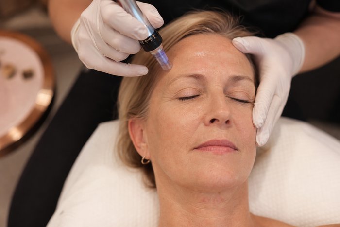 Double the Glow: Why Combining Microneedling + IPL Photofacial Works Wonders