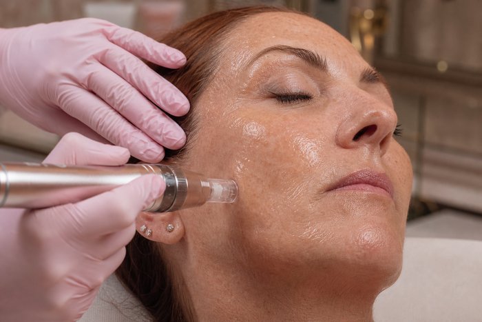 The Ultimate Skin Rejuvenation: Microneedling with PDRN