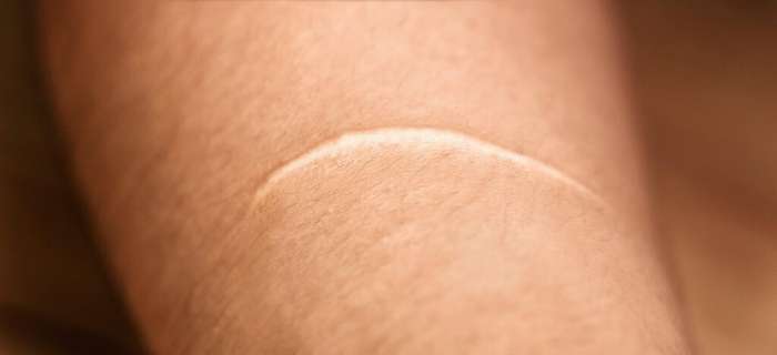 Keloid-Safe Treatments at Beauty Room TM