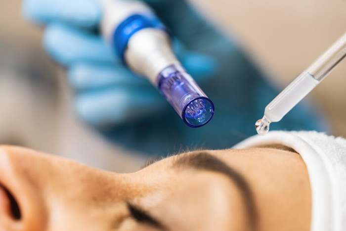 How Microneedling Improves Skin Texture: The Ultimate Game-Changer for Smooth, Radiant Skin