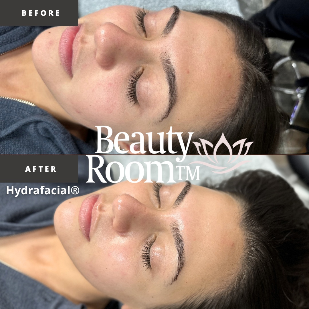 HydraFacial before and after — Immediate glow