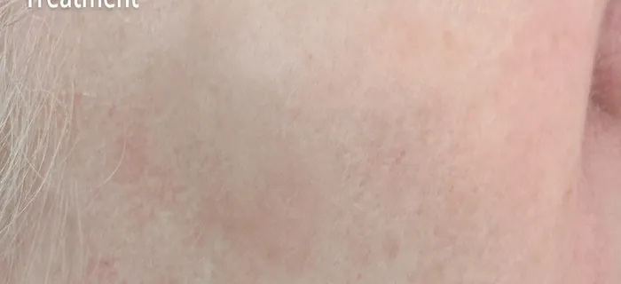 CLEAR Spot After