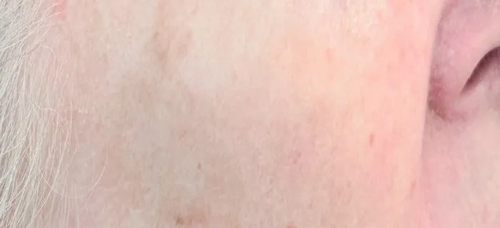 CLEAR Spot Before