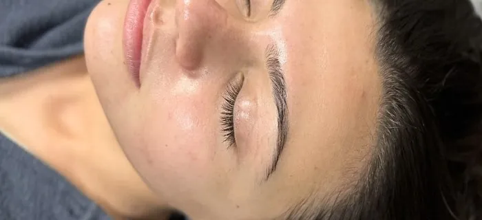 HydraFacial After