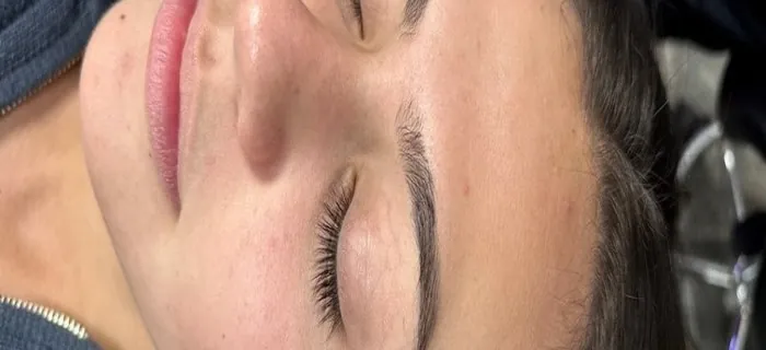 HydraFacial Before