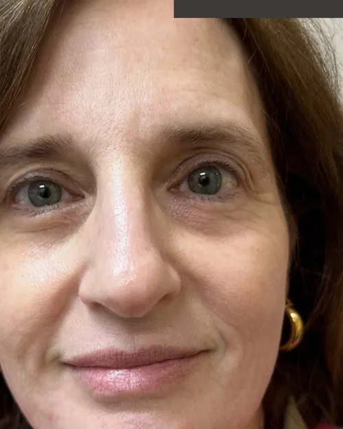 Microneedling After