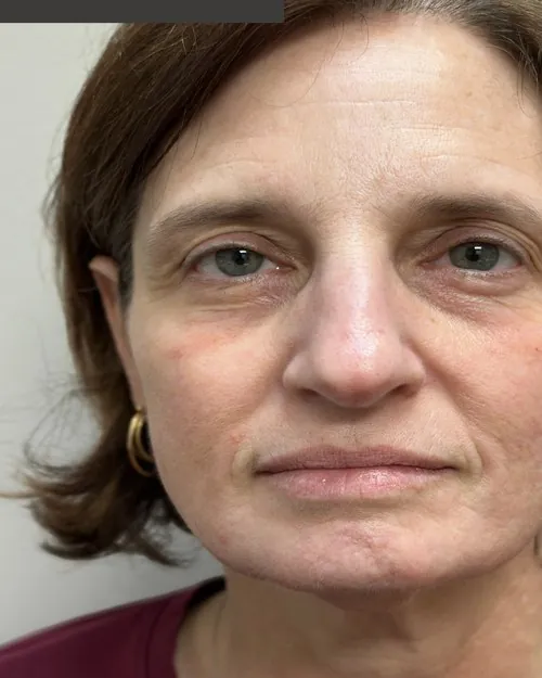 Microneedling Before