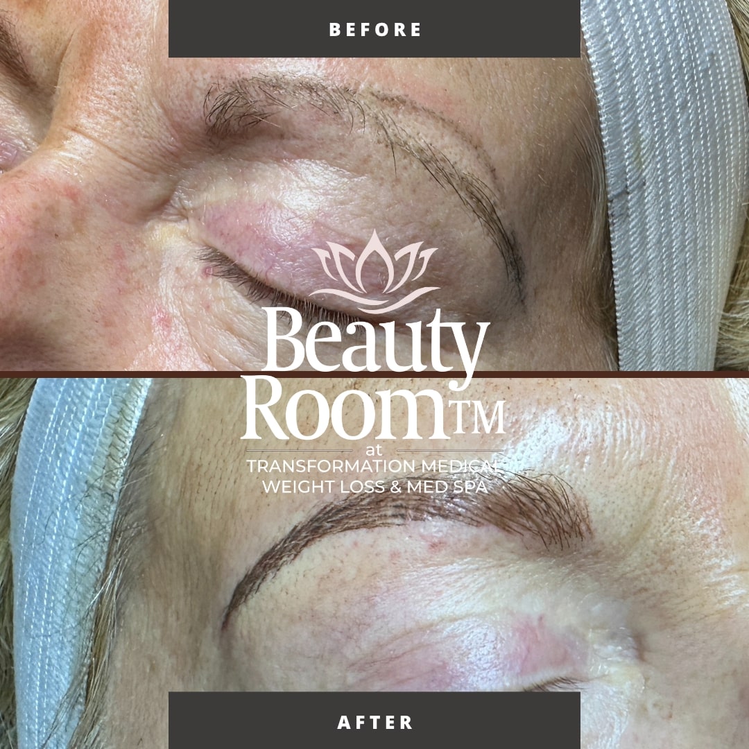 Before and After Image: NanoBrows - front