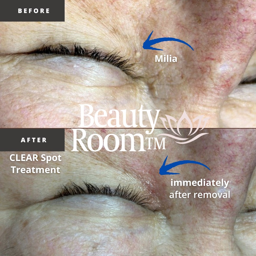 Before and After Image: Clear Spot Treatment - front