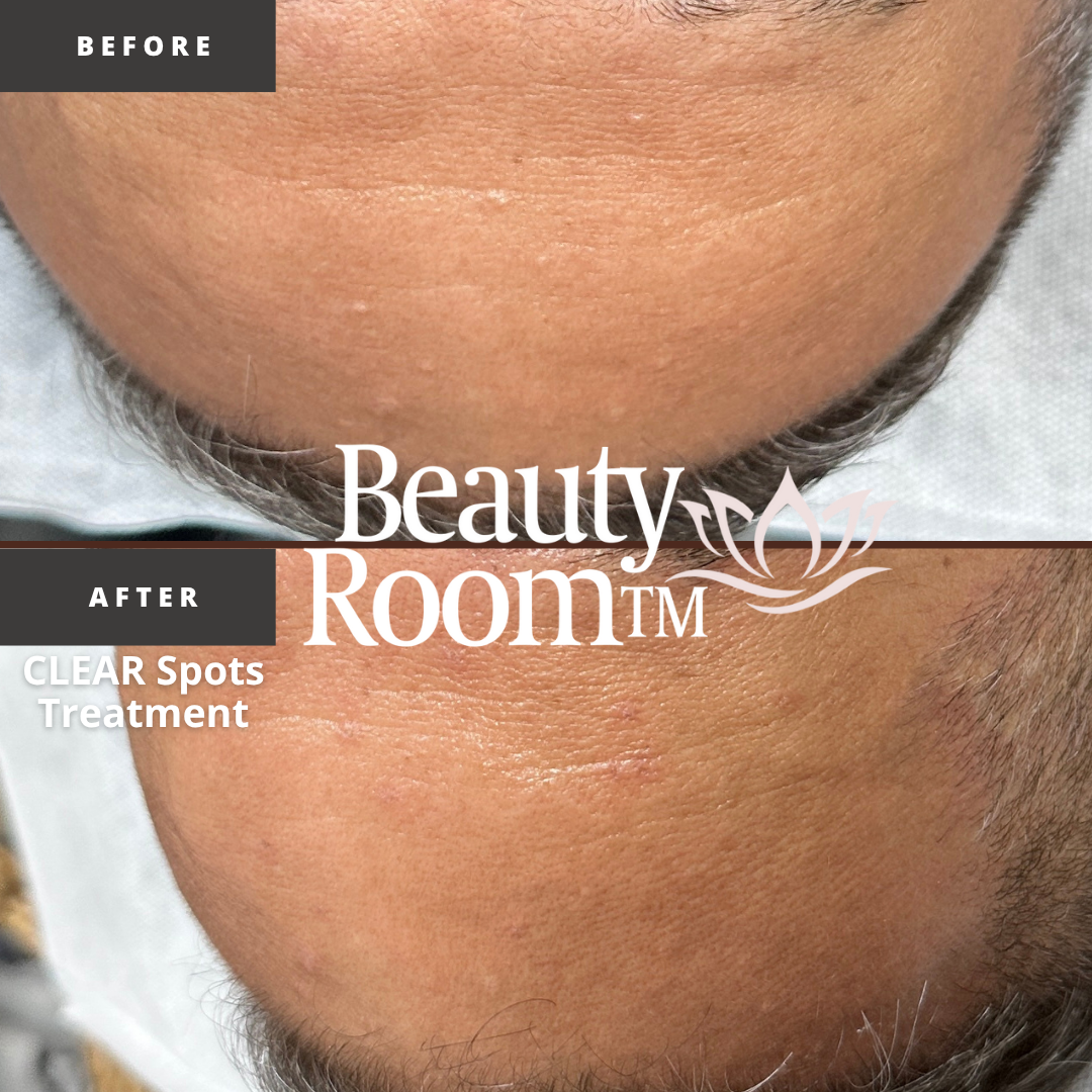 Before and After Image: CLEAR Spot Treatment - front