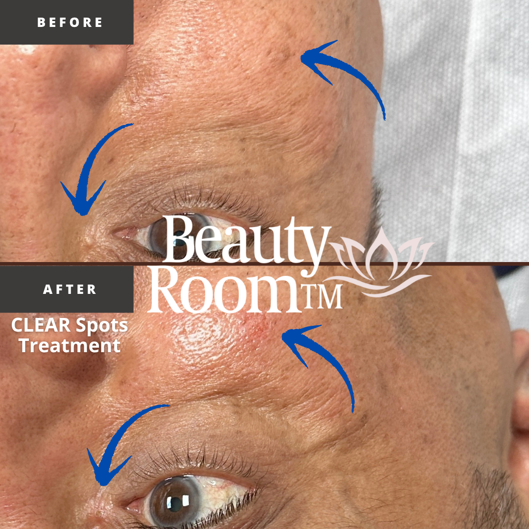 Before and After Image: CLEAR Spot Treatment - front
